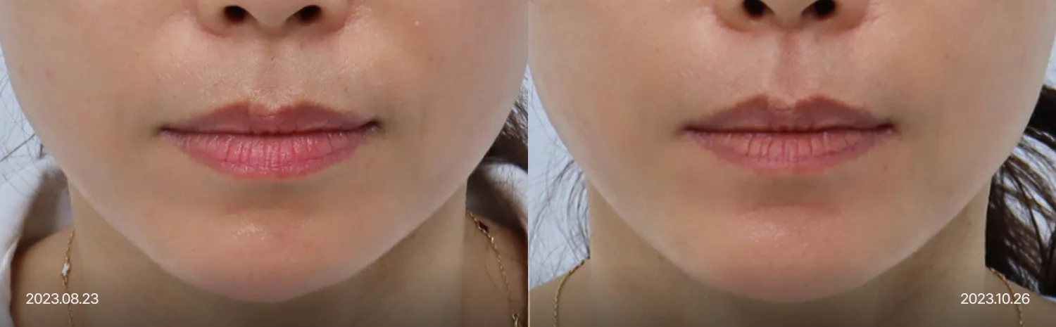 Thermage FLX AccuREP智能能量調節技術