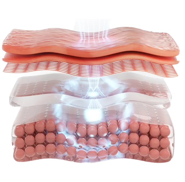 熱瑪吉射頻技術原理示意